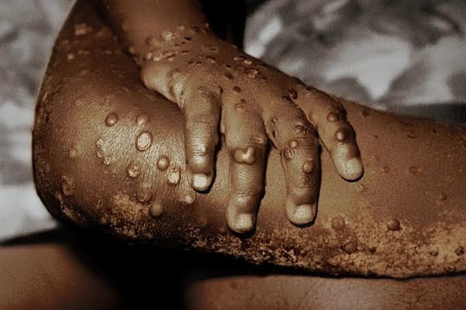 MONKEYPOX: UNDERSTANDING THE DISEASE